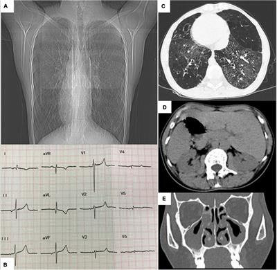 Pulmonary Hypertension in a Patient With Kartagener’s Syndrome and a Novel Homozygous Nonsense Mutation in CCDC40 Gene: A Case Report